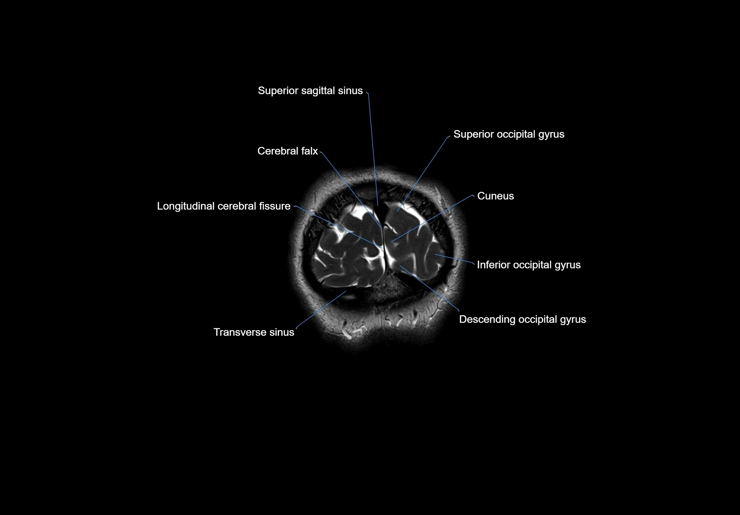 MRI Brain coronal cross sectional labelled anatomy 3T image  -img-00001-00071.webp